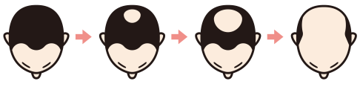 薄毛が気になった場所は、男性は「頭頂部＆前頭部」、女性は「分け目」と判明